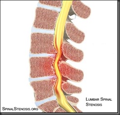 lumbar-spinal-stenosis
