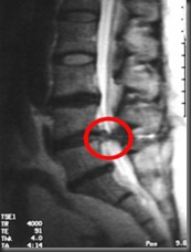 stenosis_mri